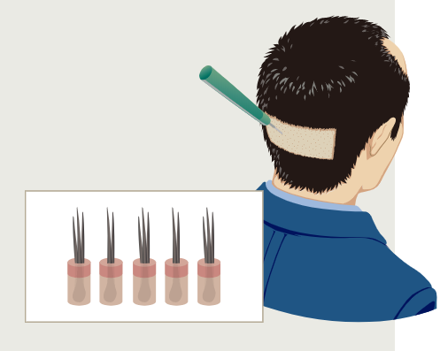 Procedure for hair transplantation