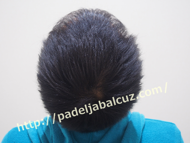 After hair transplant surgery