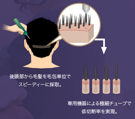 Hair root collection