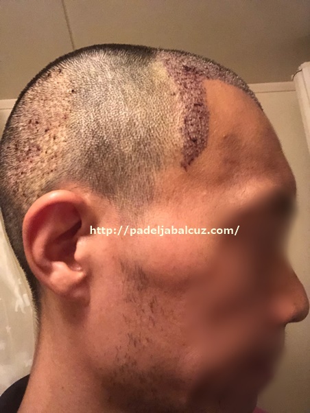 condition of the scalp on the 4th day