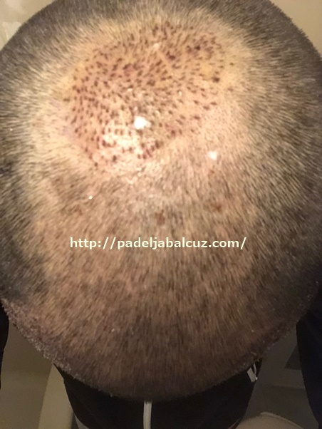 condition of the scalp on the 4th day