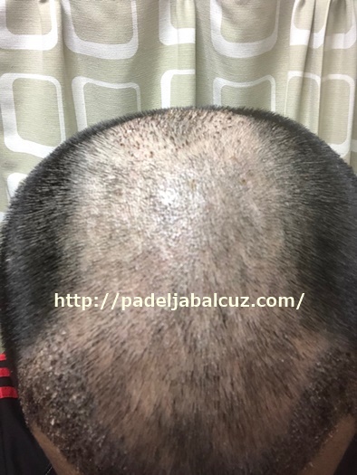 scalp after 8 days