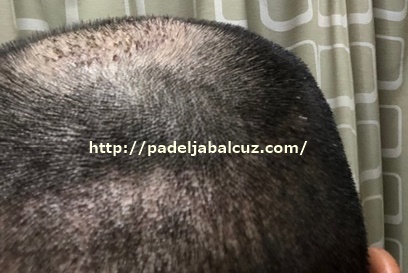 scalp after 8 days