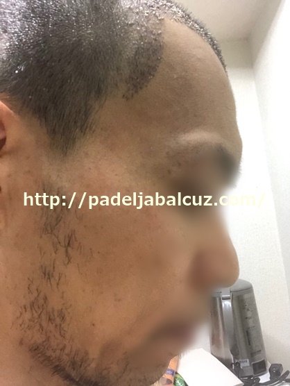 scalp after 9 days