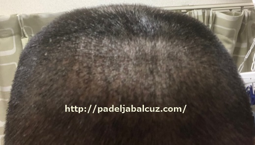 scalp after 9 days