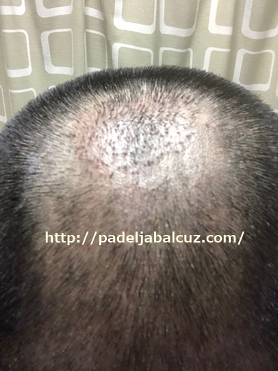 scalp after 10 days