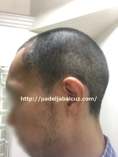 scalp after 10 days