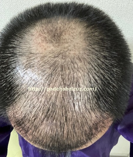 scalp after 1 month