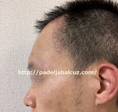 condition of the scalp after 2 months