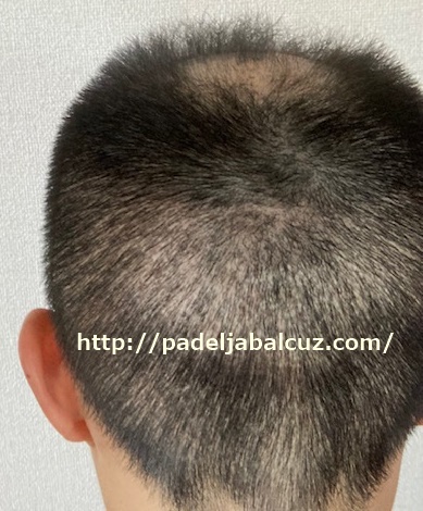 condition of the scalp after 2 months