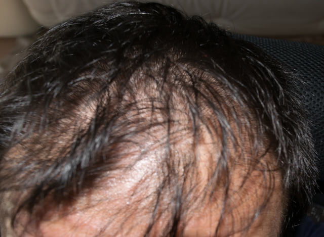 Initial hair loss